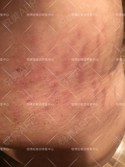 大腿上长壬辰纹_大腿上的壬辰纹_大腿有孕辰纹